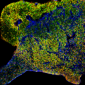 Tumor in Mouse Brain