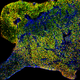 Tumor in Mouse Brain